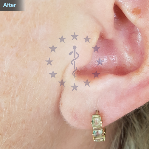 Natural and painless result after photo after earlobe repair treatment
